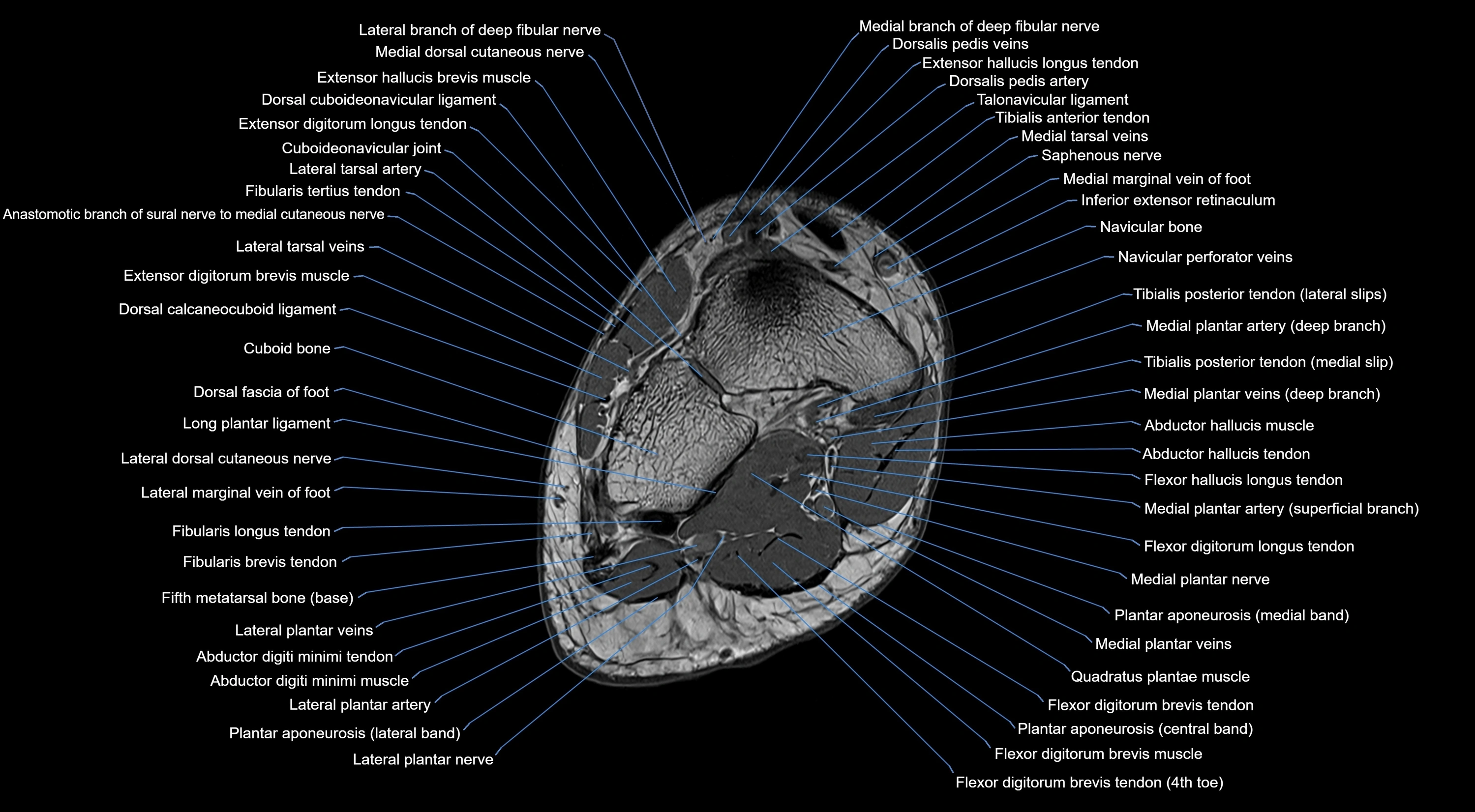 MRI mid foot coronal ligaments cross sectional anatomy 3T  radiology  image-img-00001-00030.webp